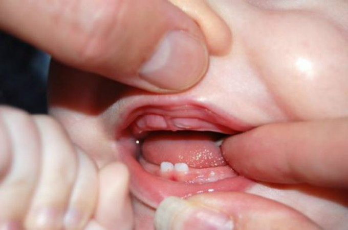 Прорізування зубів у немовлят фото
