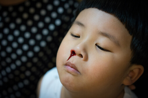 чому у дитини часто тече кров з носа