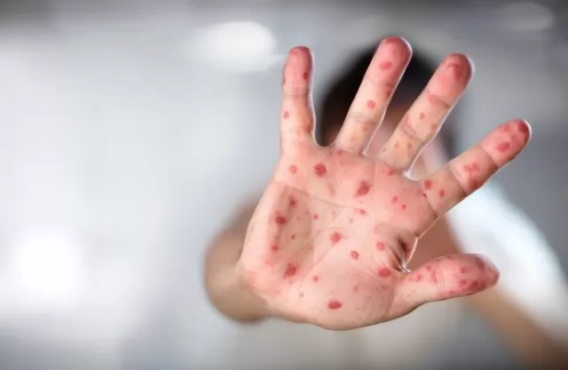 Ознаки кору. Лікування та перші симптоми кору у дітей